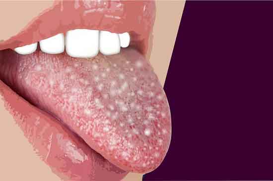 orale Candidiasis 10 Hausmittel zur Symptombekämpfung