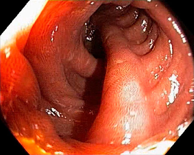 Melanosis Coli Definition, Risikofaktoren, Behandlung und mehr