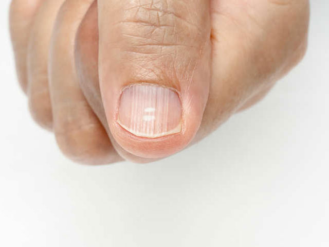 Was diese 8 Fingernageltexturen und -farben über Ihre Gesundheit aussagen