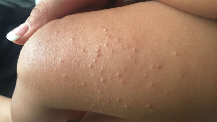 Molluscum contagiosum (Dellwarze) Definition, Ursachen, Symptome, Behandlung