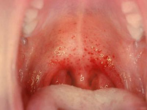 Pharyngitis Ursachen, Symptome, Heimbehandlung