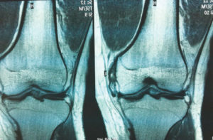 Medial Collateral Ligament Injury Of The Knee (MCL Tear) - Evolving World