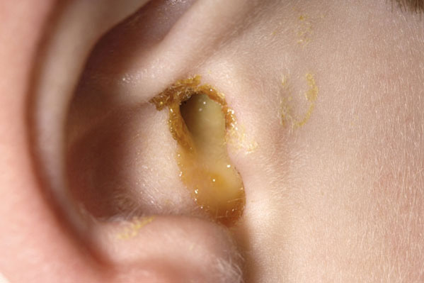 Ear Discharge: Causes, Treatments, and Prevention - Evolving World